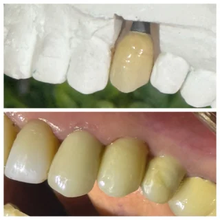 Alegria em devolver sorrisos! Na primeira foto uma coroa sobre implante no modelo de gesso, na segunda foto a coroa já instalada em função mastigatória e estética, mimetizando perfeitamente as características dos dentes adjacentes! Trabalho impecável do laboratório @labmmdentalceramic para uma paciente muito querida #implantes #cargaimediata #protesesobreimplante